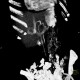 Portocaval shunt in liver, VRT: CT - Computed tomography